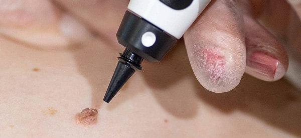After Skin Tag Removal Wellingborough