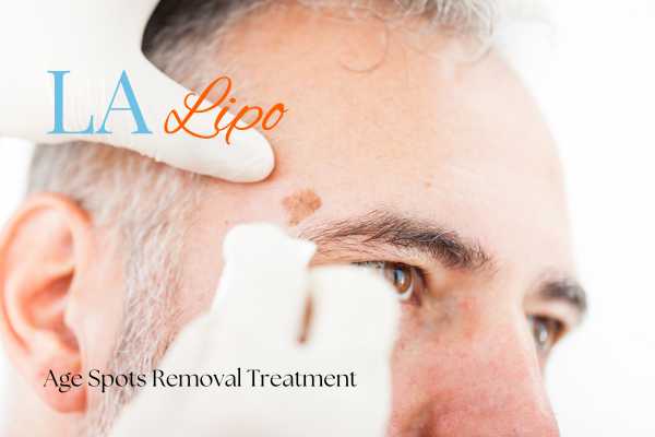 What Are the Most Effective Treatments for Age Spots Wellingborough?