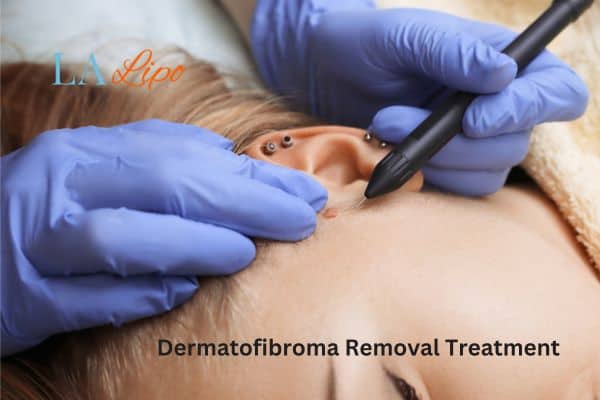 Dermatofibroma Removal Treatment Wellingborough