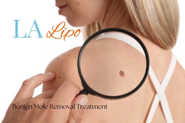 Woman having her inspection of blemish before mole removal Wellingborough