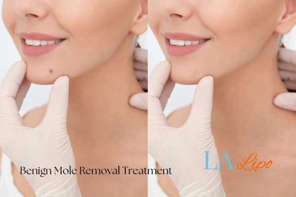 Before and after mole removal Wellingborough treatment