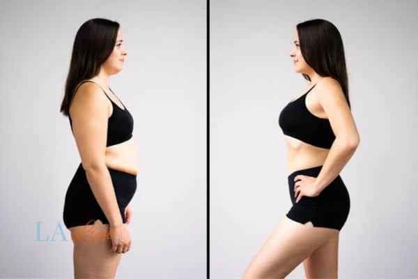 image of woman before and after results of LA-EMS Body Sculpting Wellingborough to help treat Diastasis recti