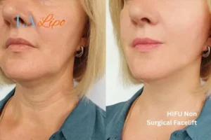 hi-fu for wrinkles Wellingborough before and after results
