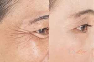 Before and after results of woman - HI-fu wrinkles reduction treatment Wellingborough