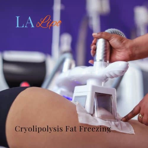 fat freezing - Cryolipolysis Wellingborough