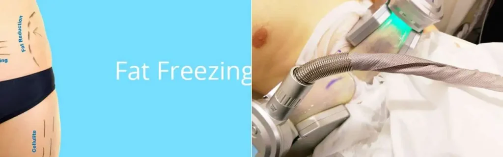 multi areas of a persons body having coolsculpting Wellingborough treatment