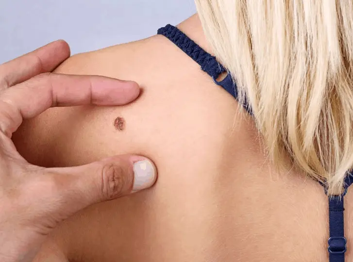 woman having mole removal Wellingborough consultation before treatment.