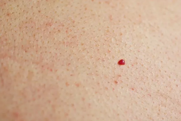 close up of a cherry angioma Wellingborough