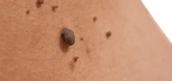 image of a skin tag Wellingborough