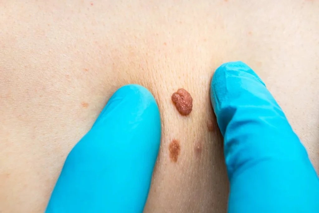 Consultant examining a skin tag Wellingborough