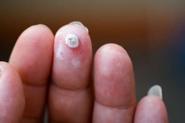 wart on person finger - cryotherapy to treat from LA LIPO Wellingborough