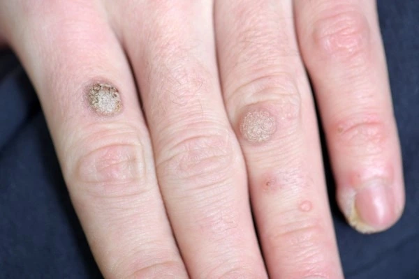 photo of warts on person hand - see wart removal Wellingborough from LA LIPO