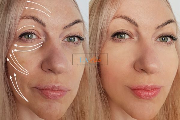 Morpheus 8 results Wellingborough face lift.