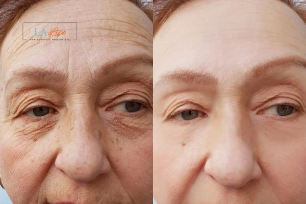 The powerful benefits of Morpheus8 Treatment Wellingborough - Call Our team today!