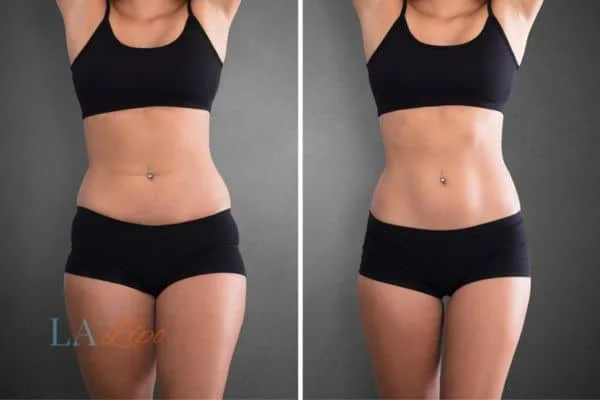 before and after results of non-surgical treatment to help a woman's body image and mental health Wellingborough