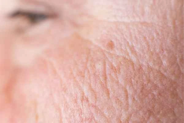 close up picture of a woman's face showing an age spot Wellingborough