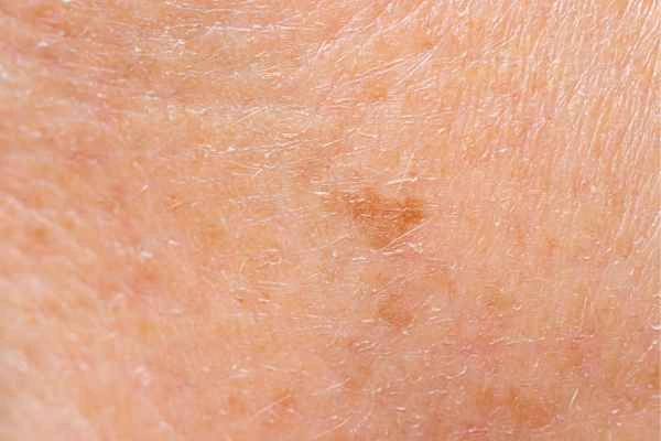 close up picture of age spots Wellingborough