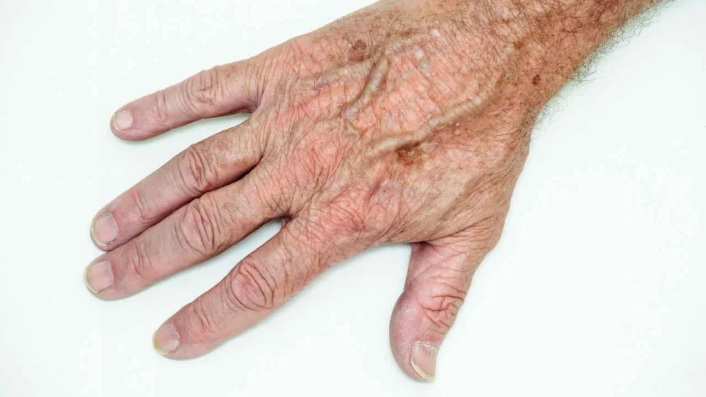Male hand showing age spot Wellingborough
