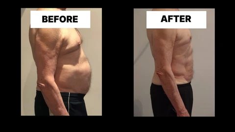 What Symptoms Can Diastasis Recti Cause in Men? Weak Core, Back Pain and Poor Posture Wellingborough